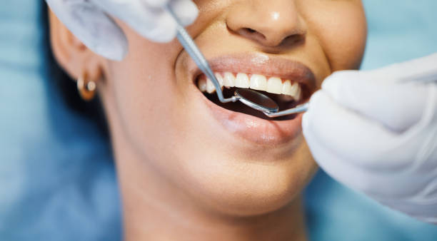 Best Emergency Dentist for Lost Fillings or Crowns in Soquel, CA